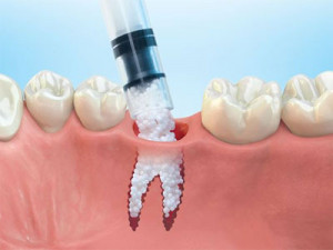 injerto-oseo-dental-hueso-implantes-dentales