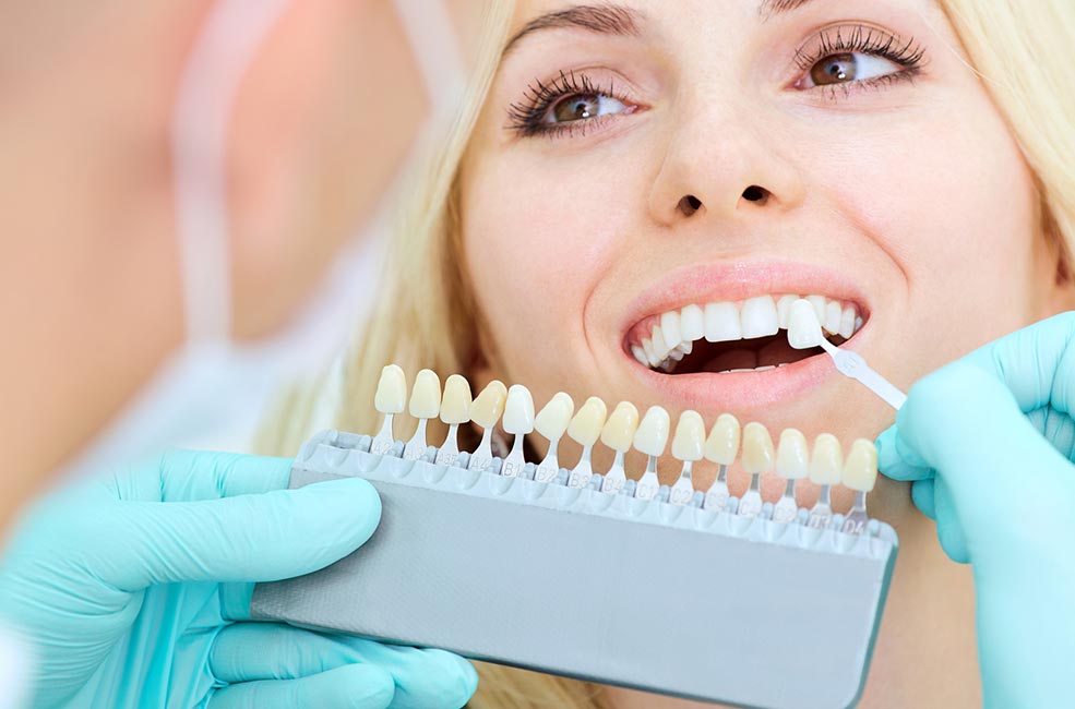 carillas dentales de composite y porcelana tratamiento estético dental