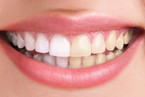 portada blanqueamiento dental