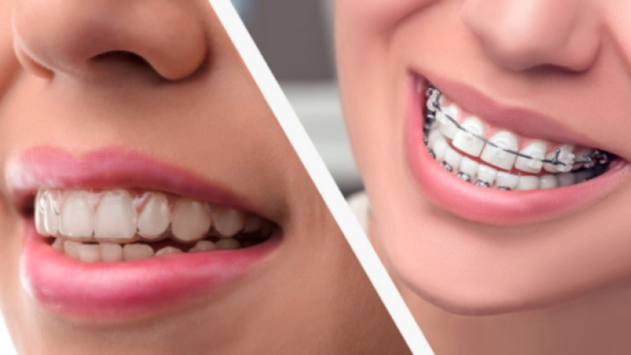 técnica invisalign