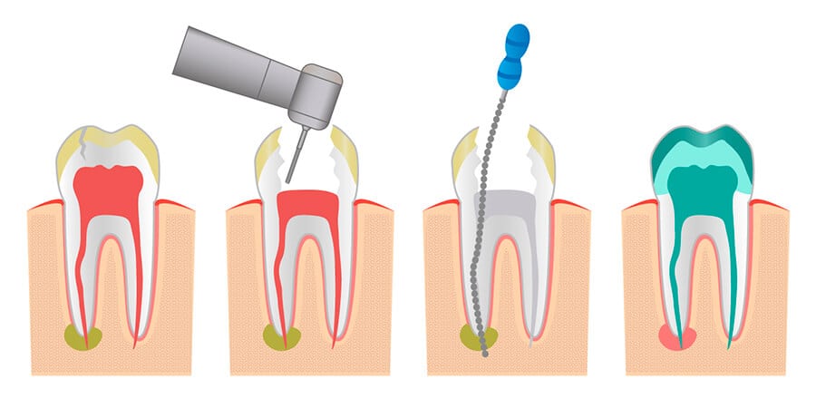 tratamiento endodoncia