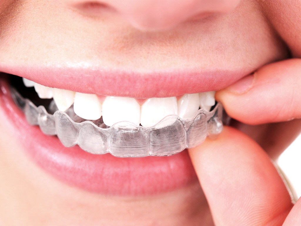 50 por ciento de descuento en tratamiento invisalign