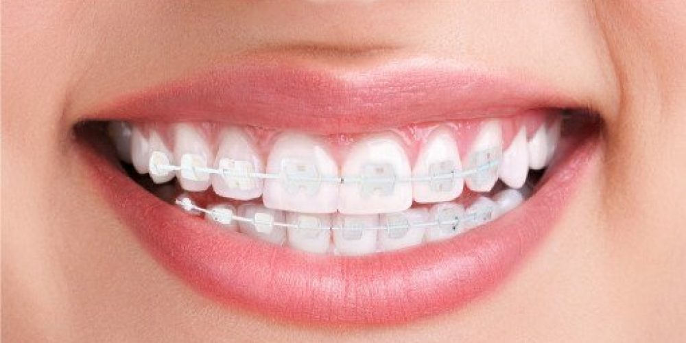 brackets de porcelana menos visibles tratamiento ortodoncia